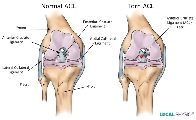 Diagram of torn dog ACL